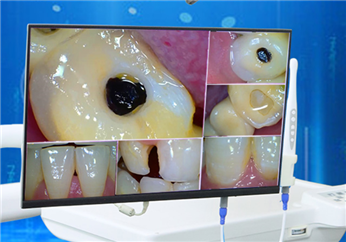 CF-988 wifi口腔内窥镜+21.5寸超高清液晶屏一体机